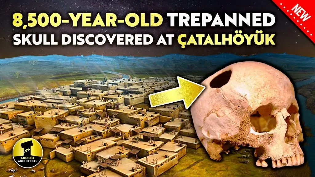 8,500-Year0Old Trepanned Skull Çatalhöyük